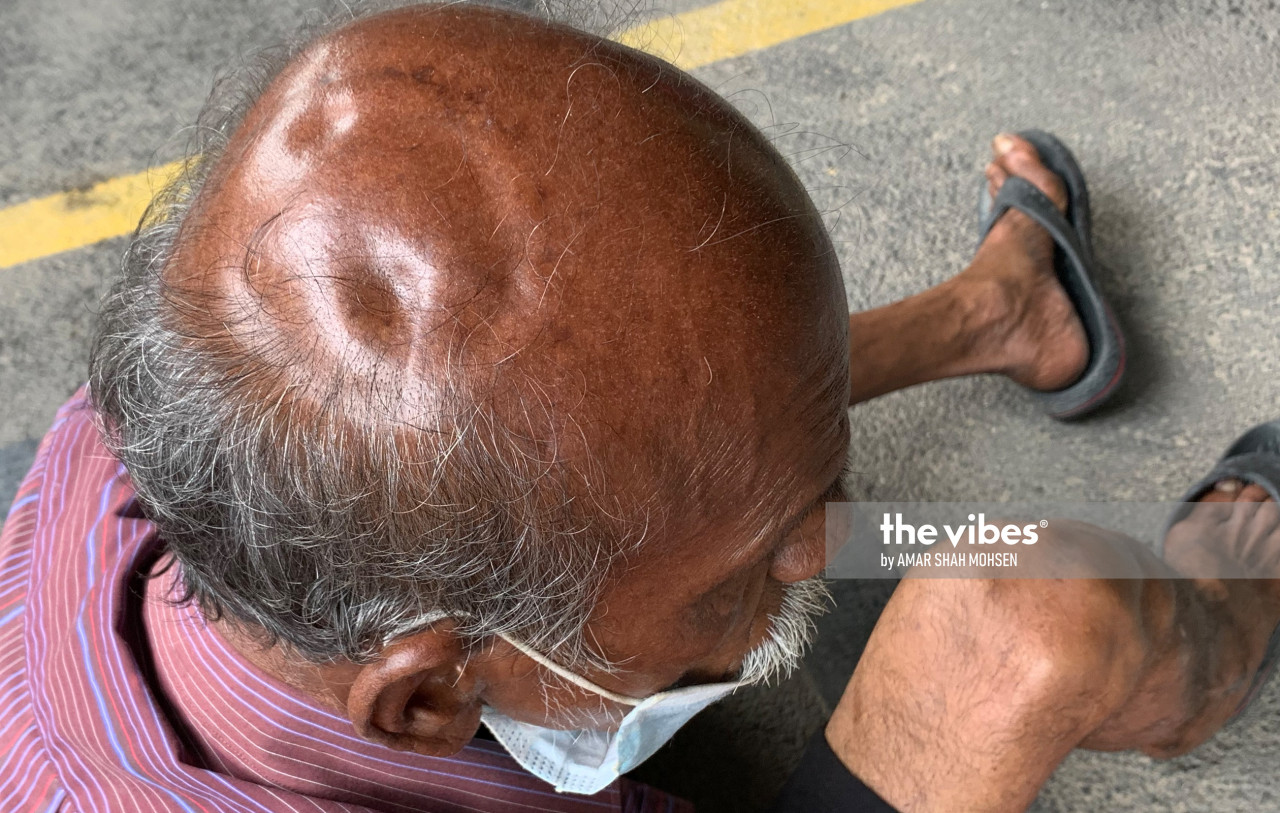 Tewarajan showing the part of his head that went through surgery back in 2011. AMAR SHAH MOHSEN/The Vibes pic, October 2, 2020