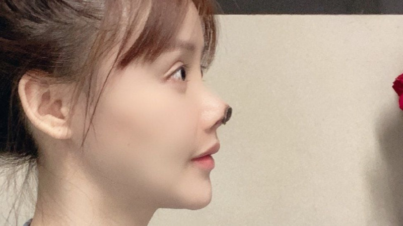 Chinese actress shares photos of botched nose surgery