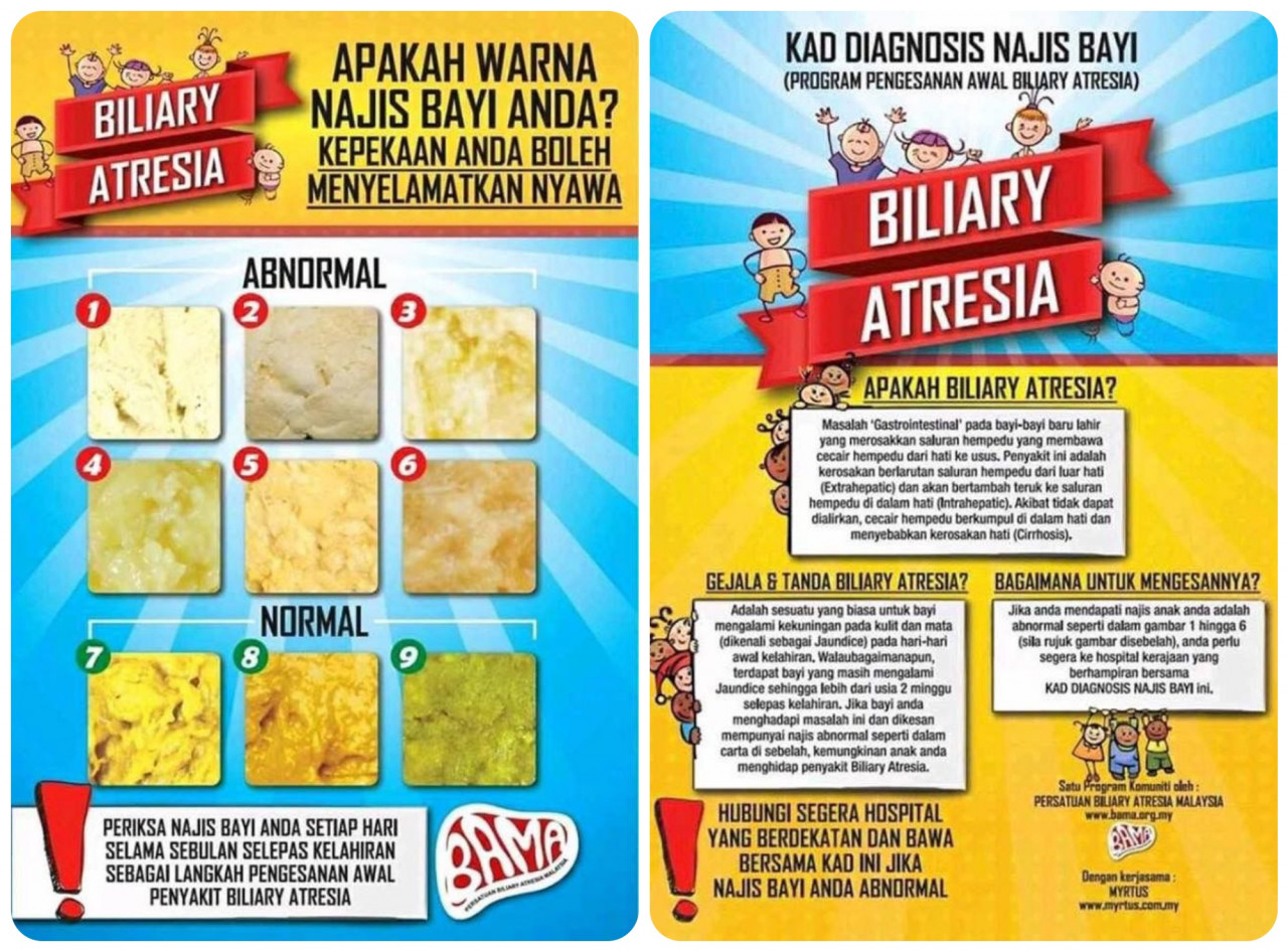 An infographic describing how to detect biliary atresia. – Pic courtesy of BAMA