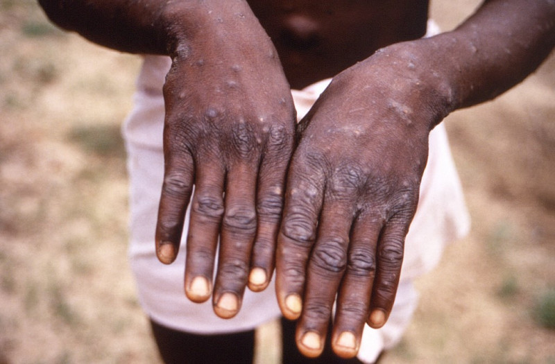 Monkeypox: 'too early to call it an epidemic'