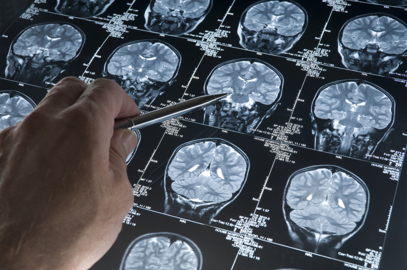 Potential 'game-changer' in diagnosing Parkinson's disease
