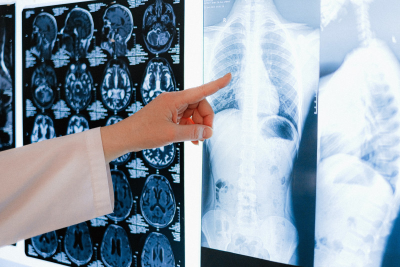 Unknown and irreversible and deadly: pulmonary fibrosis is a respiratory killer
