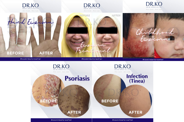 Skin diseases such as psoriasis and eczema are chronic immune-related conditions characterised by skin inflammation. — Dr. Ko Skin Specialist pic