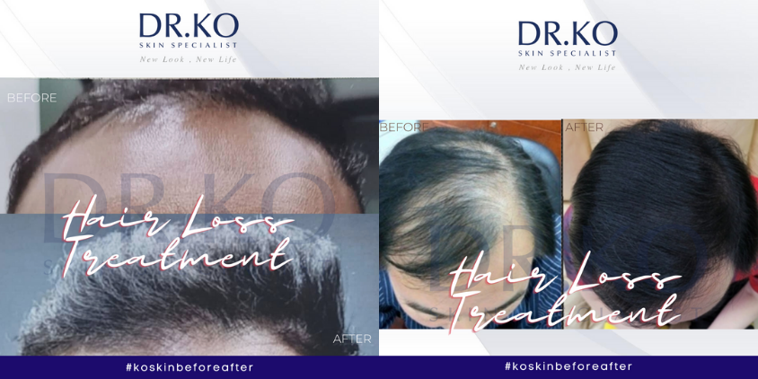 Aside from the scalp, balding can occasionally occur on other hair-bearing areas such as the eyebrows, moustache, or beard. — Dr. Ko Skin Specialist pic