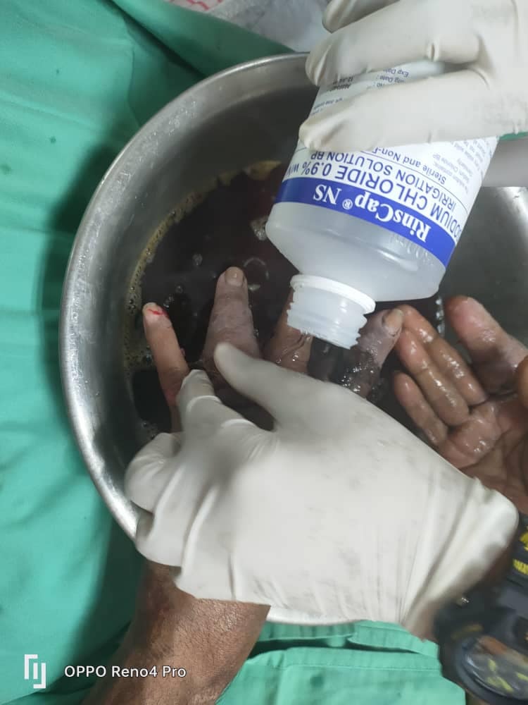 The hand injury victim is having his hands washed in a sodium chloride solution before receiving further treatment. – Teluk Intan Bomba Facebook pic, December 5, 2023. 