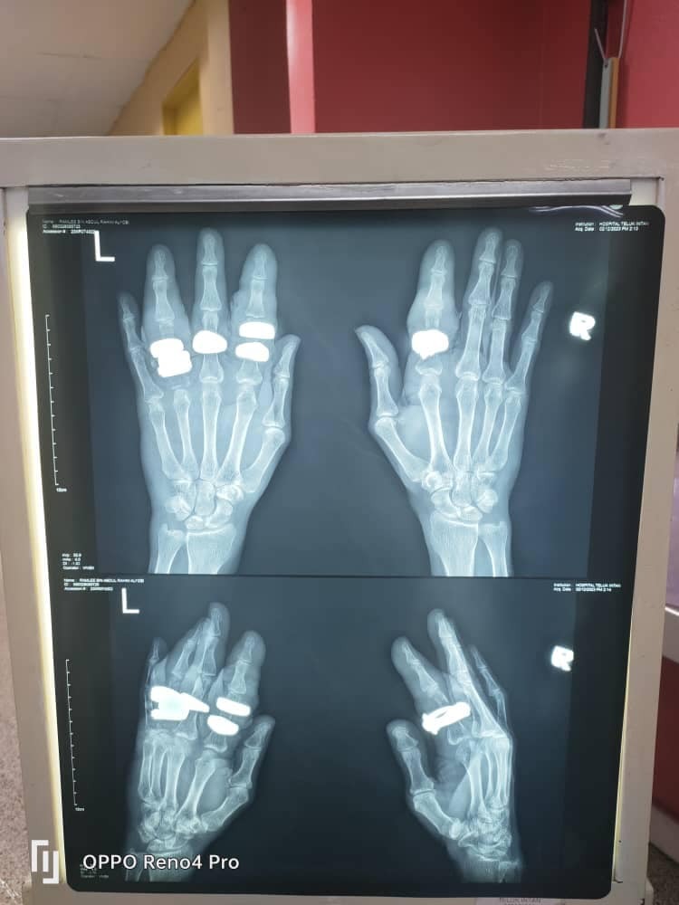 The Teluk Intan Fire and Rescue Services Department has managed to remove rings from a victim’s swollen digits. – Teluk Intan Bomba Facebook pic, December 5, 2023. 