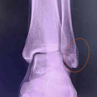 An X-ray image showing Chua Kah Yi's fractured ankle and the bone splintering inwards. She said race director, Jeff Ooi, paid her a visit at the hospital only to apologise, but refused to take any responsibility for the incident. – Pic courtesy of Chua Kah Yi, January 26, 2023