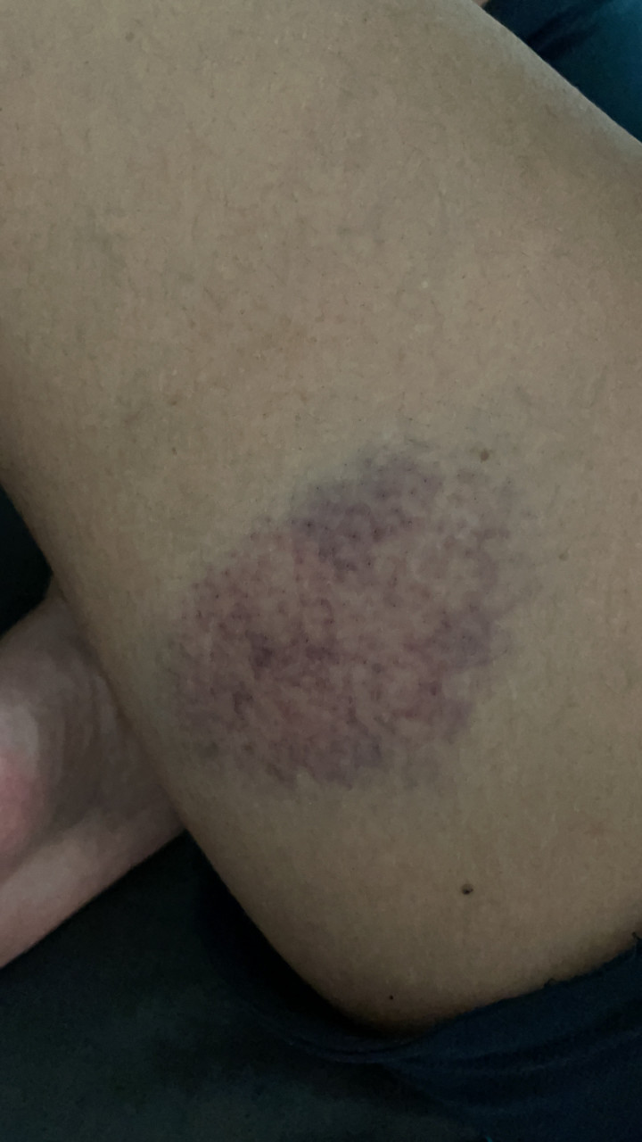 A huge bruise Sharifah Davina Syed Salehuddin sustained in the accident yesterday. – Sharifah Davina Syed Salehuddin pic, May 25, 2021