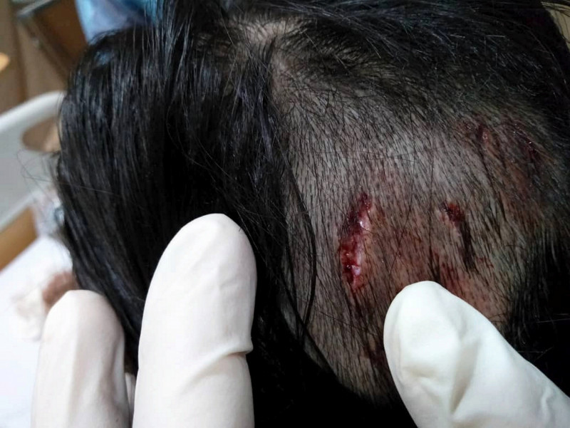 Girl, 11, hurt in Wangsa Maju stray dog attack