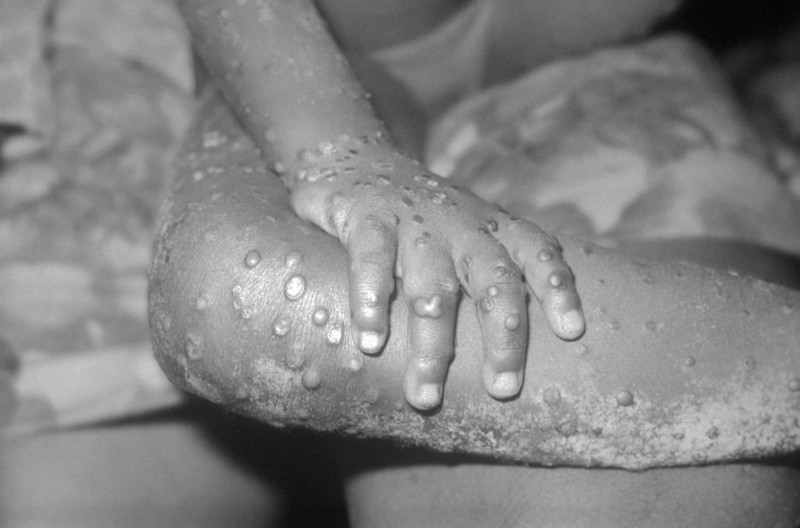 Canada reports dozen suspected cases of rare monkeypox virus