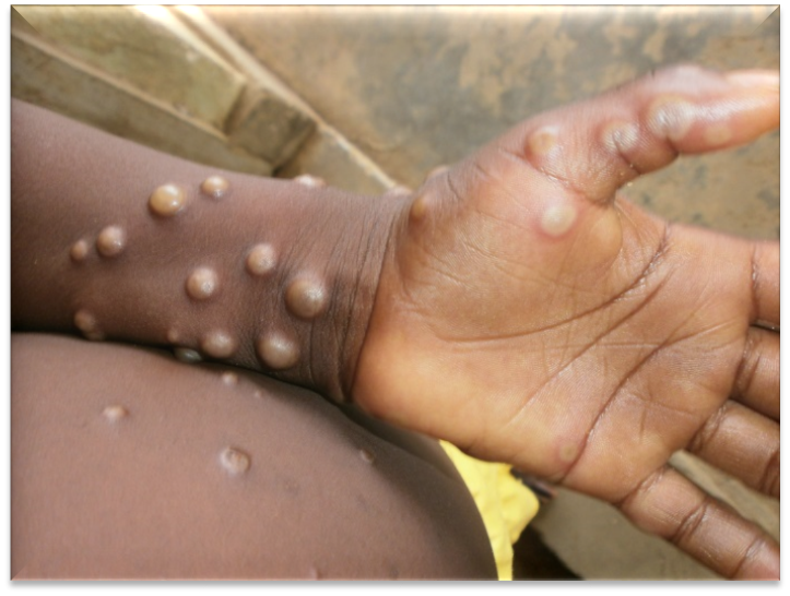 Health Ministry denies receiving info on monkeypox infection
