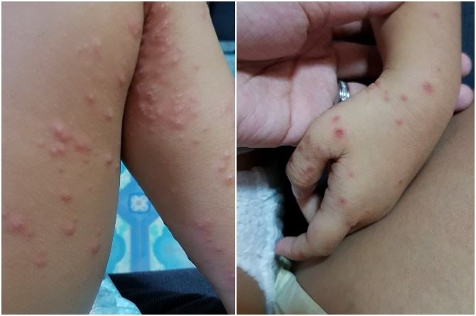 Operators of childcare centres and kindergartens urged to step up HFMD screenings