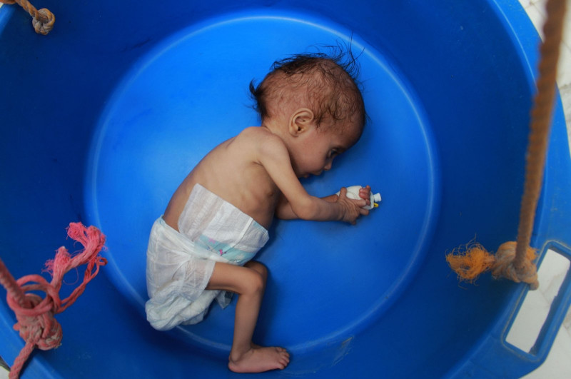 Child malnutrition surges in war-torn Yemen: UN