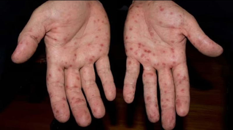 Penang sees sharp surge in Hand, Foot, And Mouth Disease cases in early 2025