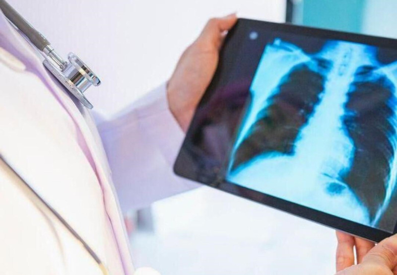 Tuberculosis resurfaces in Malaysia: Experts warn of rising cases amid greater awareness