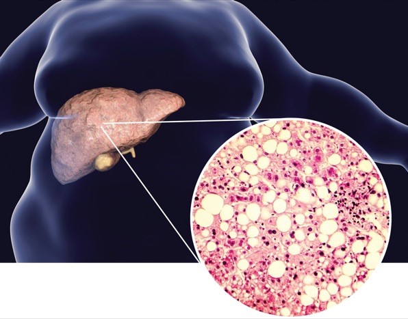 Obesity and Diabetes driving silent surge in liver disease across Malaysia