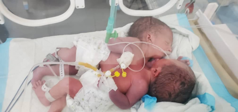 Conjoined Yemeni twins flown to Jordan for surgery: Unicef